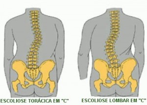 escolioseC