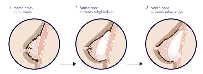 Assim fica mais fácil de entender a diferença entre colocar os implantes antes ou depois do músculo. ;)